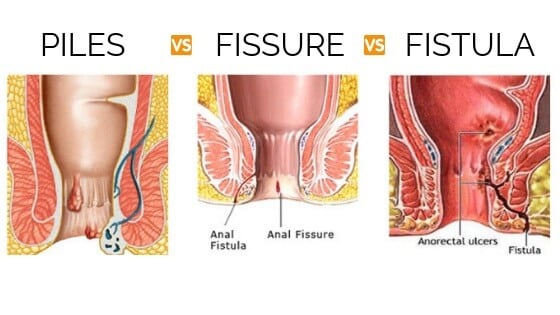 Hemorrhoids removal and anal fissures