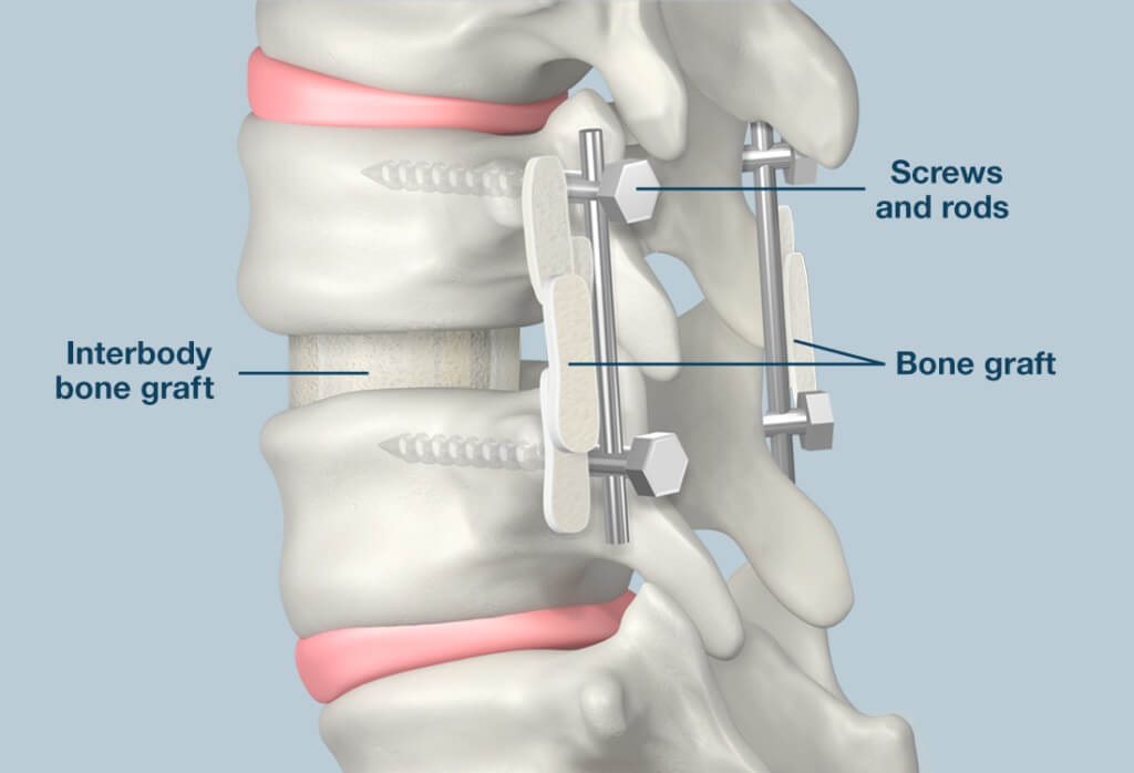 spine fusion