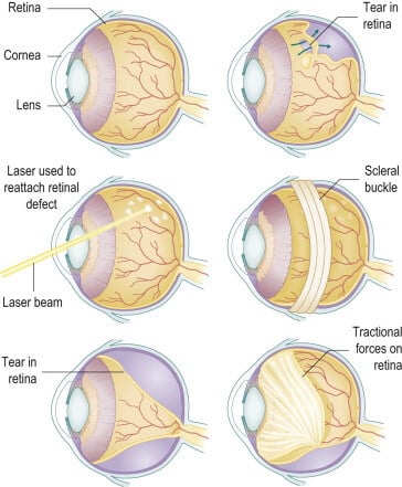 retinopathy