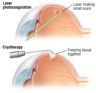 retinopathy