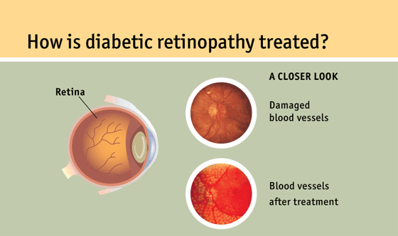 detached retina treatment