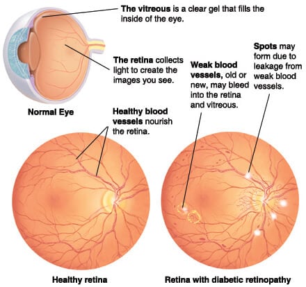 retinopathy