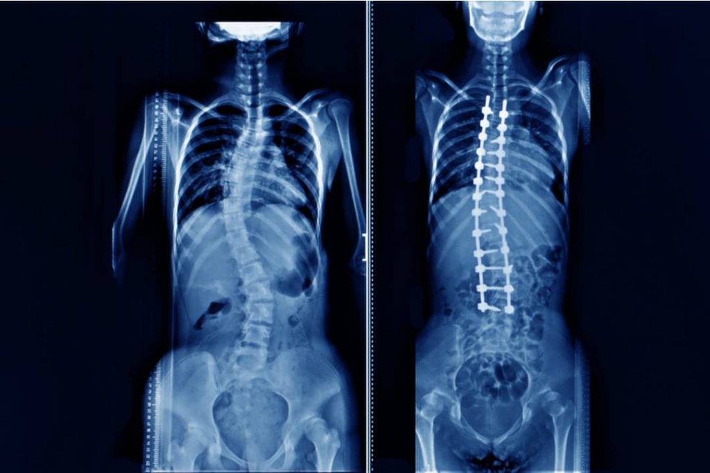 Scoliosis