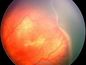 retinopathy