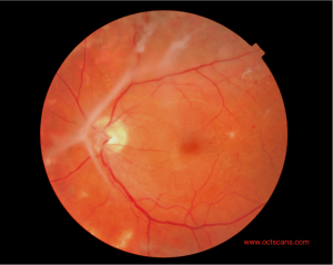 retinopathy