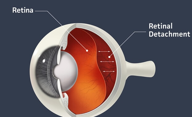 retinopathy