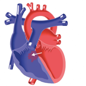 Ventricular Septal Defect (VSD) Repair: surgery & catheter procedure -Iran