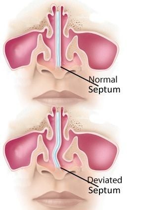 septoplasty