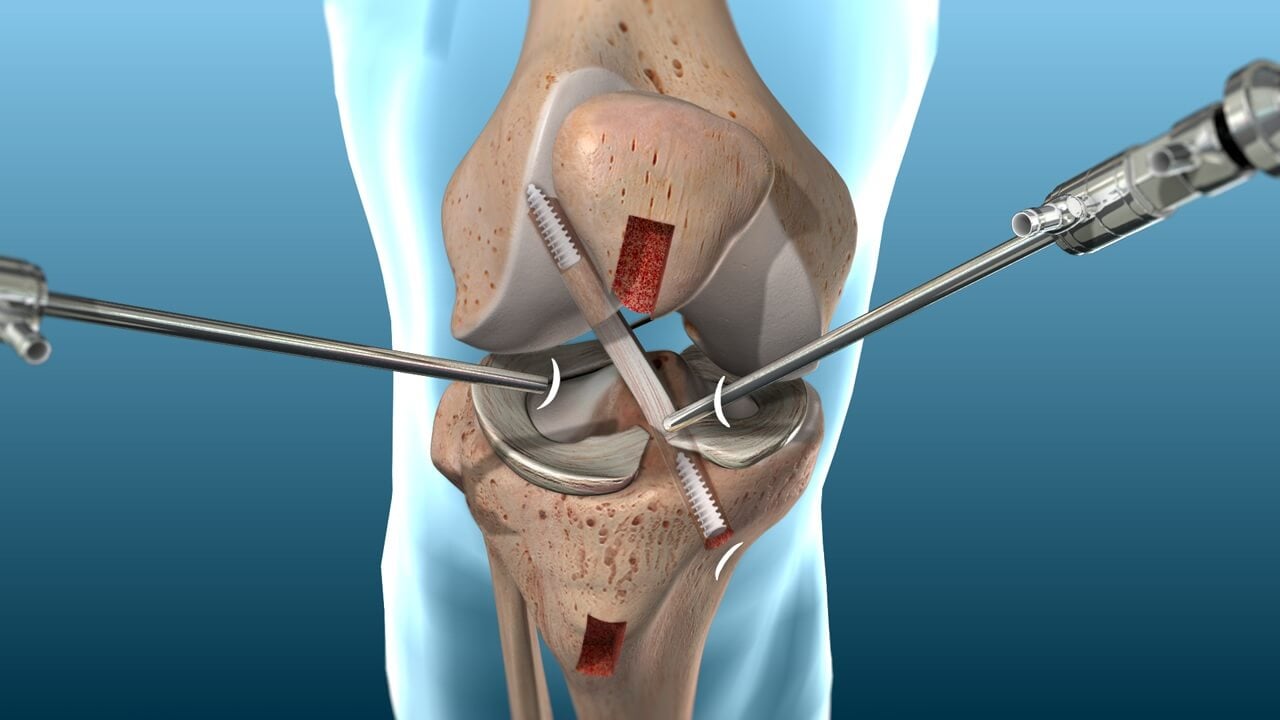 How Is The Pain After Acl Surgery