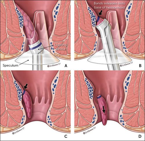 Hemorrhoids removal and anal fissures