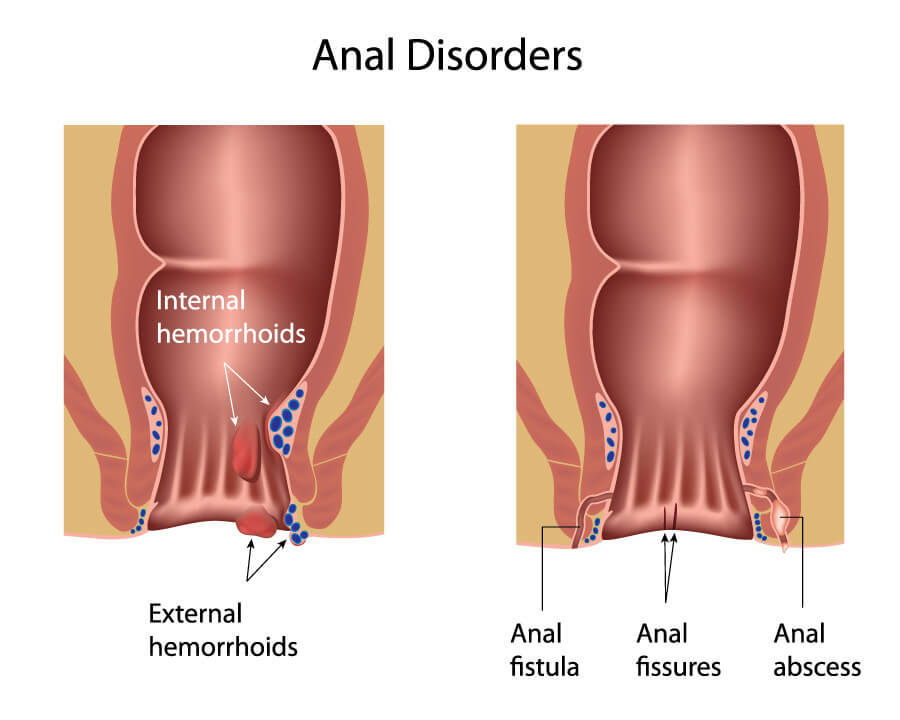 Hemorrhoids removal and anal fissures