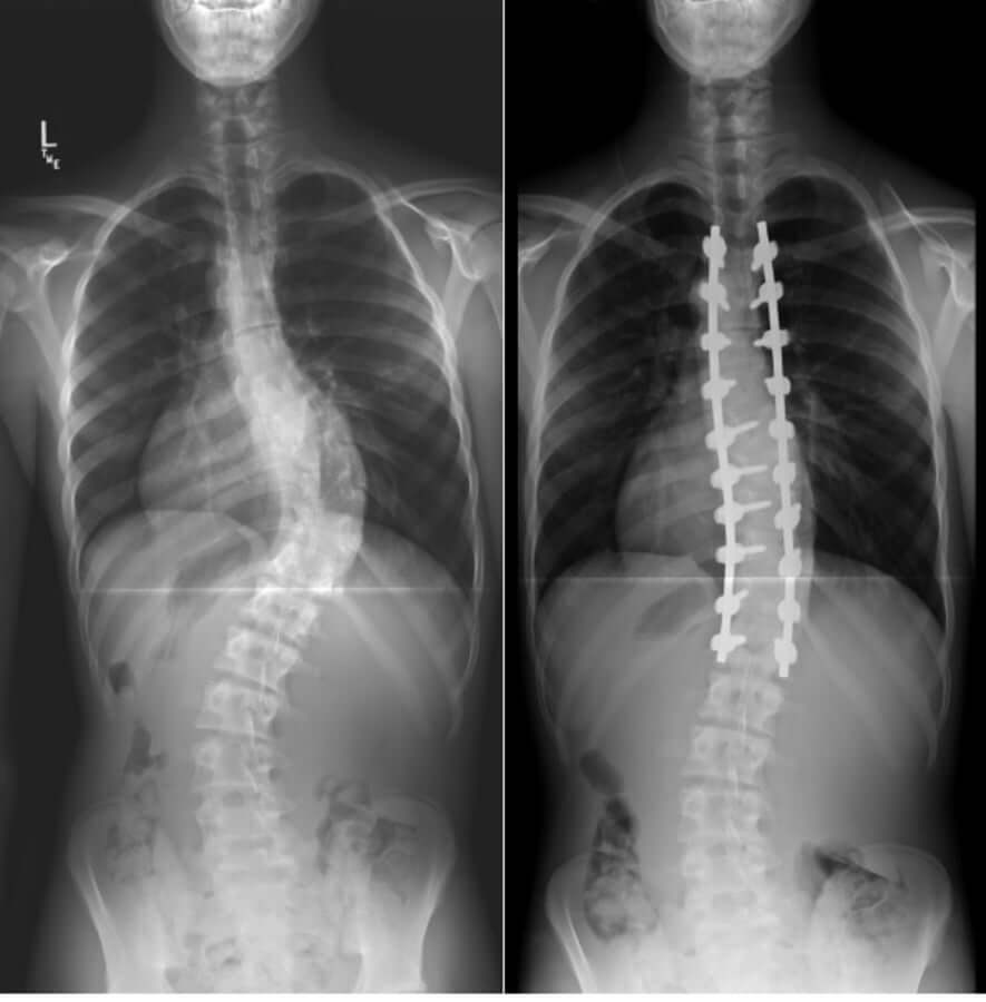 Posterior spinal fusion