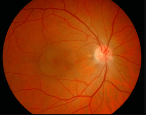 retinopathy