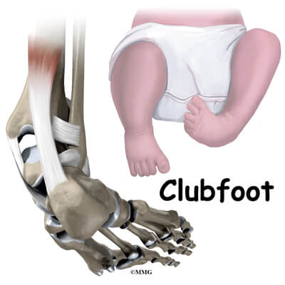 Clubfoot Treatment In Iran Best Doctors Clinics Free Consultation