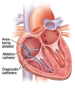 EPS ablation