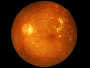 retinopathy