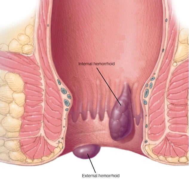 Hemorrhoids removal and anal fissures