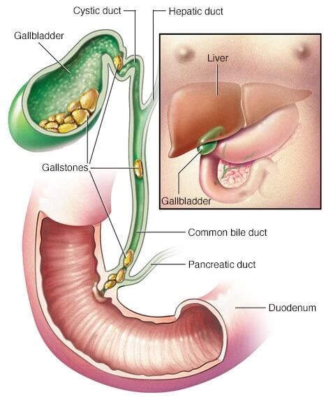 cholecystectomy