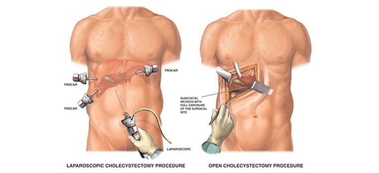 cholecystectomy