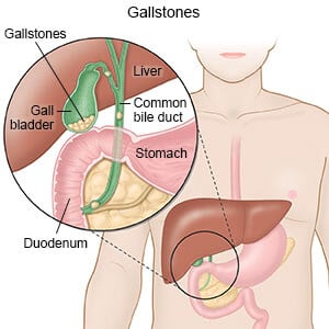 cholecystectomy