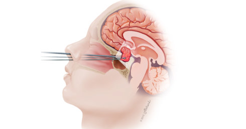 Endoscopic brain surgery