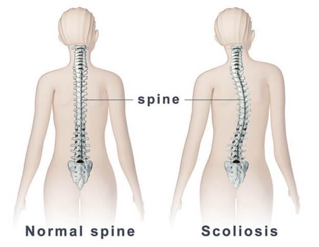 Scoliosis