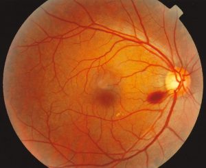 retinopathy