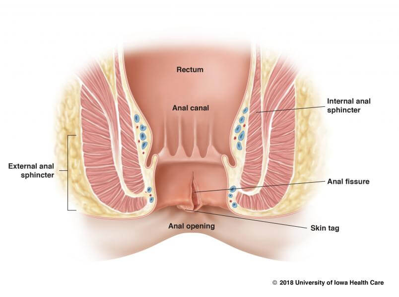 Hemorrhoids removal and anal fissures