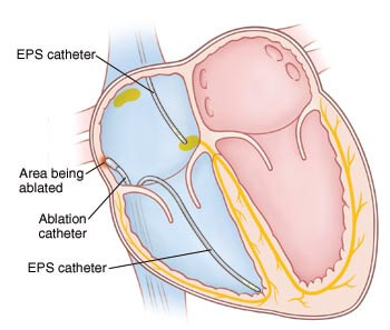 EPS ablation