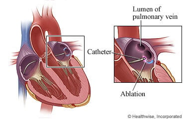 EPS ablation