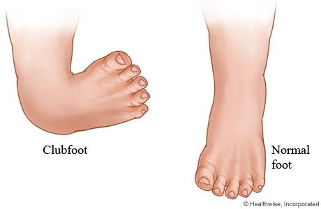 clubfoot