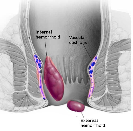 Hemorrhoids removal and anal fissures