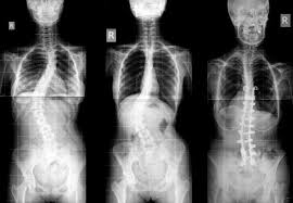 Scoliosis