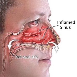 sinusitis