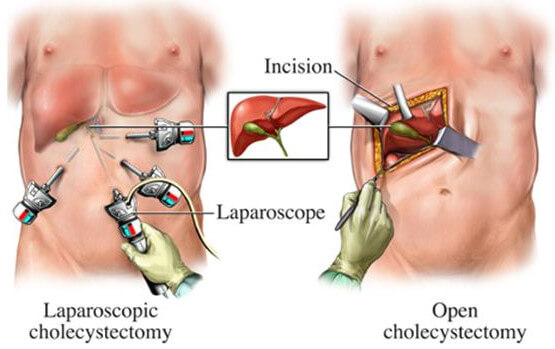 cholecystectomy