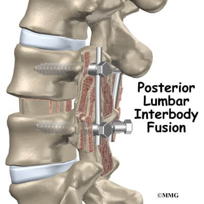 Posterior spinal fusion