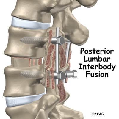 lumbar_plif_intro01