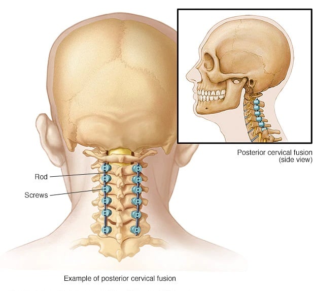 mcdc7_cervical_posterior_fusion-8col