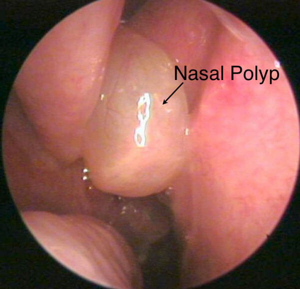 Nasal polyp