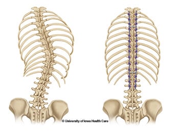 posterior-spinal-fusion-before-and-after-skeletal-illustration