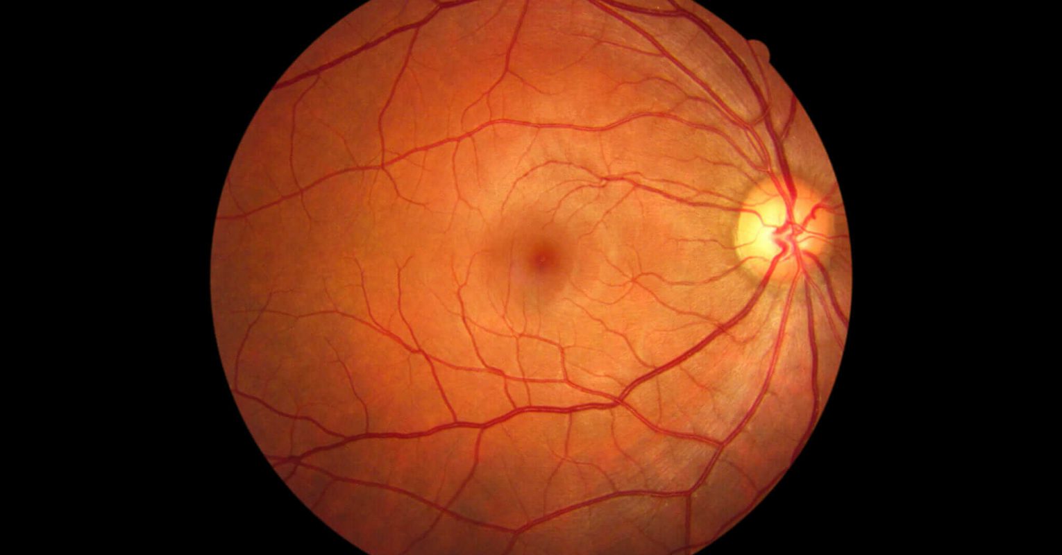 vision loss normal lens normal retina