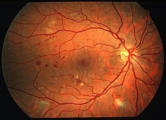 retinopathy