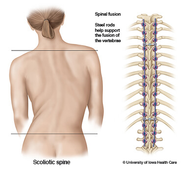 Posterior spinal fusion