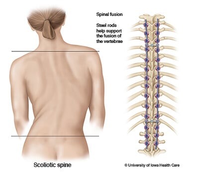 scoliotic-spine-steel-rods