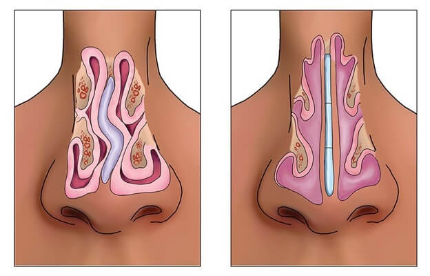 septoplasty