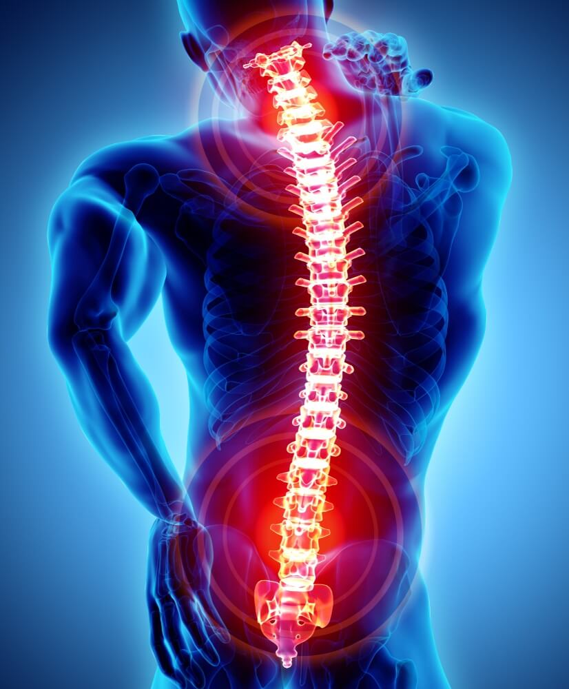 Posterior spinal fusion