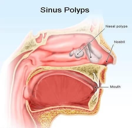 Nasal polyp