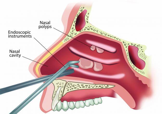 Intranasal polypectomy hot sale