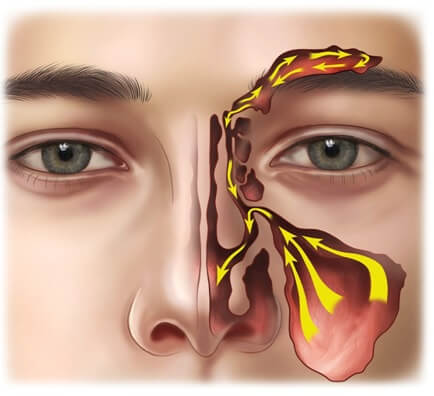 sinusitis