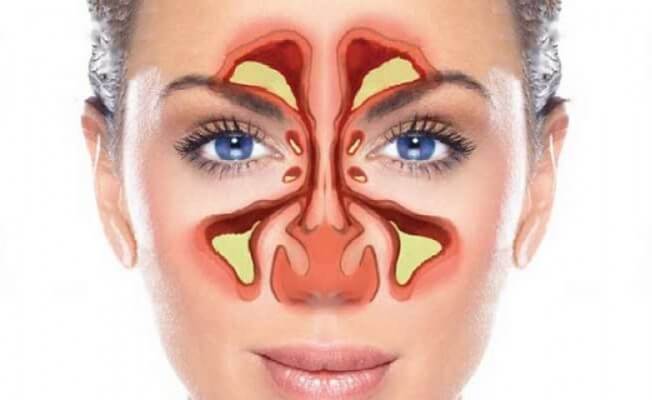 sinusitis